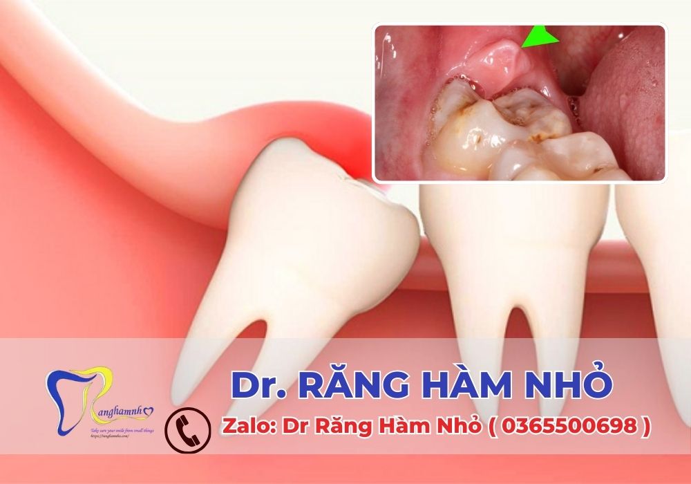 Viêm lợi trùm là tình trạng phần nướu (lợi) bọc phủ lên một phần hoặc toàn bộ răng khôn khi chiếc răng này mọc chưa hoàn thiện hoặc mọc lệch.