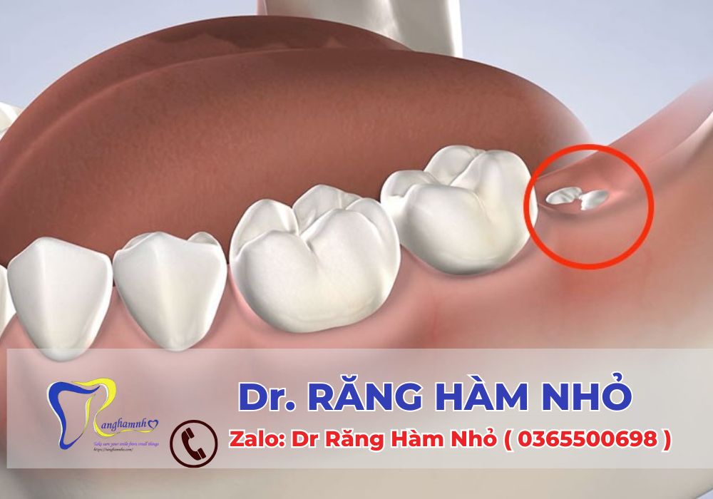 Nhổ răng khôn là một thủ thuật nha khoa rất phổ biến, nhưng vẫn khiến nhiều người băn khoăn về những tác động có thể xảy ra sau khi thực hiện.