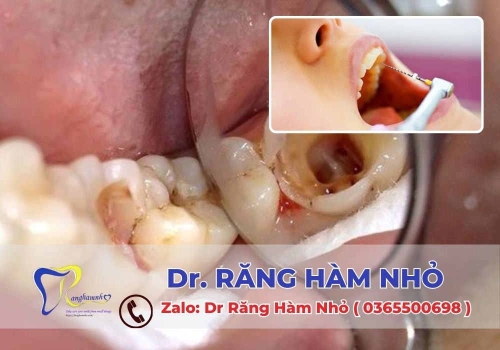 Sau khi thực hiện chữa tủy răng, việc bảo vệ và phục hồi chức năng răng miệng là rất quan trọng để đảm bảo sức khỏe lâu dài cho răng.