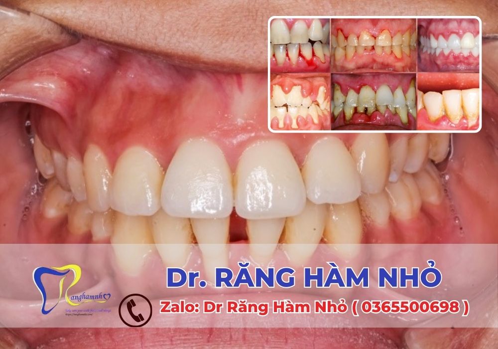 Nếu tình trạng chảy máu lợi kéo dài hoặc không có dấu hiệu cải thiện sau khi thực hiện chăm sóc răng miệng cơ bản, bạn cần đến gặp bác sĩ nha khoa ngay.