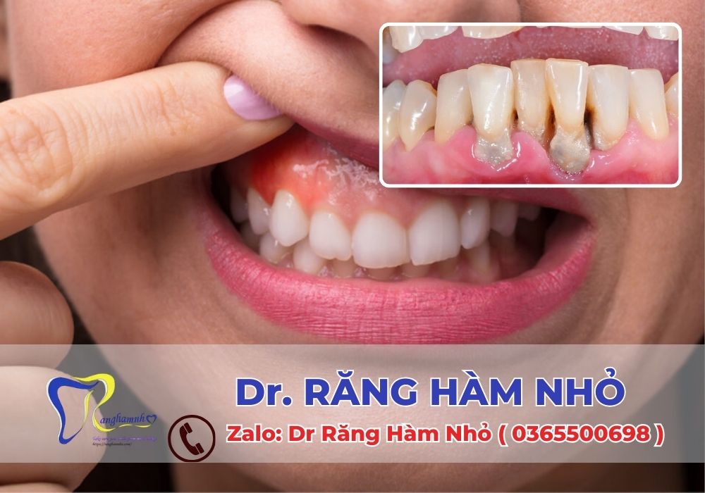 Điều trị nha chu sớm và đúng cách không chỉ cứu lấy răng thật mà còn nâng cao chất lượng cuộc sống.