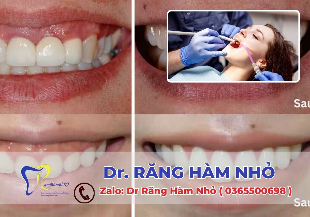 Tại Dr RĂNG HÀM NHỎ, chúng tôi có đội ngũ bác sĩ chuyên sâu về phẫu thuật nha chu, áp dụng công nghệ hiện đại và đảm bảo vô trùng tuyệt đối trong mọi quy trình điều trị.