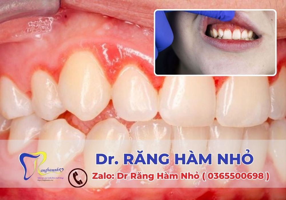 Dr RĂNG HÀM NHỎ luôn sẵn sàng hỗ trợ bạn trong việc điều trị các bệnh lý về lợi.