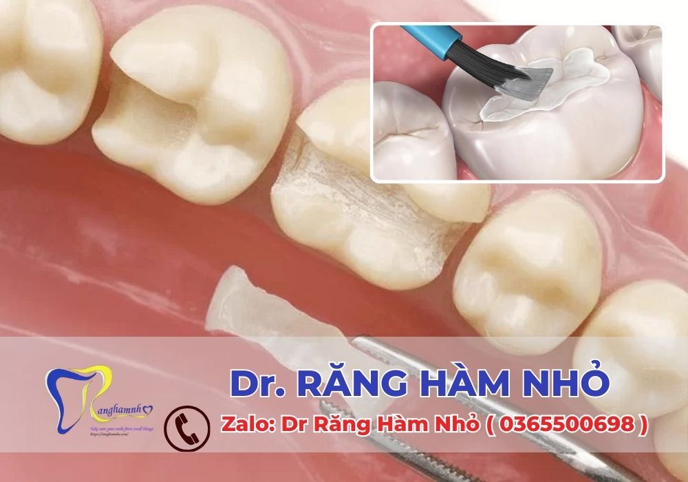 Hàn răng thẩm mỹ là một phương pháp hiệu quả giúp phục hồi hình dáng và chức năng của răng, đồng thời mang lại nụ cười tự tin