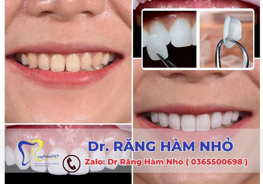 Dán sứ veneer là một giải pháp nha khoa thẩm mỹ lý tưởng. Giúp bạn có được một hàm răng đẹp và tự tin.