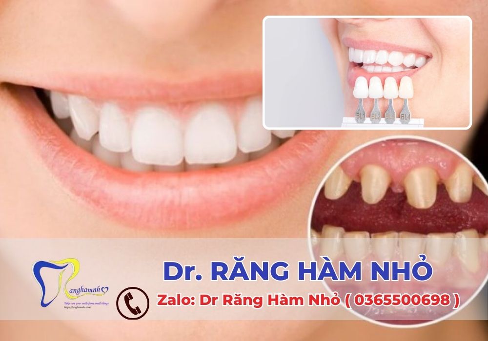 Răng sứ thẩm mỹ mang lại nhiều lợi ích vượt trội cả về mặt thẩm mỹ lẫn chức năng ăn nhai.