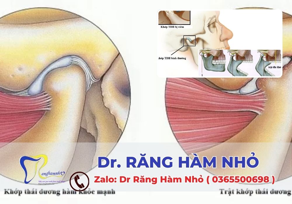 Rối loạn khớp thái dương hàm là một vấn đề phổ biến nhưng có thể điều trị hiệu quả nếu được phát hiện và chăm sóc đúng cách.