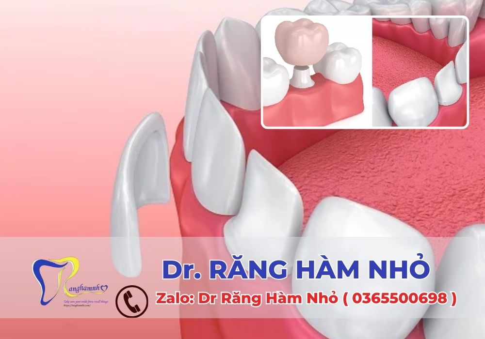 Với nhiều năm kinh nghiệm, các bác sĩ tại Dr RĂNG HÀM NHỎ đã thực hiện hàng ngàn ca dán sứ veneer và bọc răng sứ, mang lại nụ cười hoàn hảo cho khách hàng.