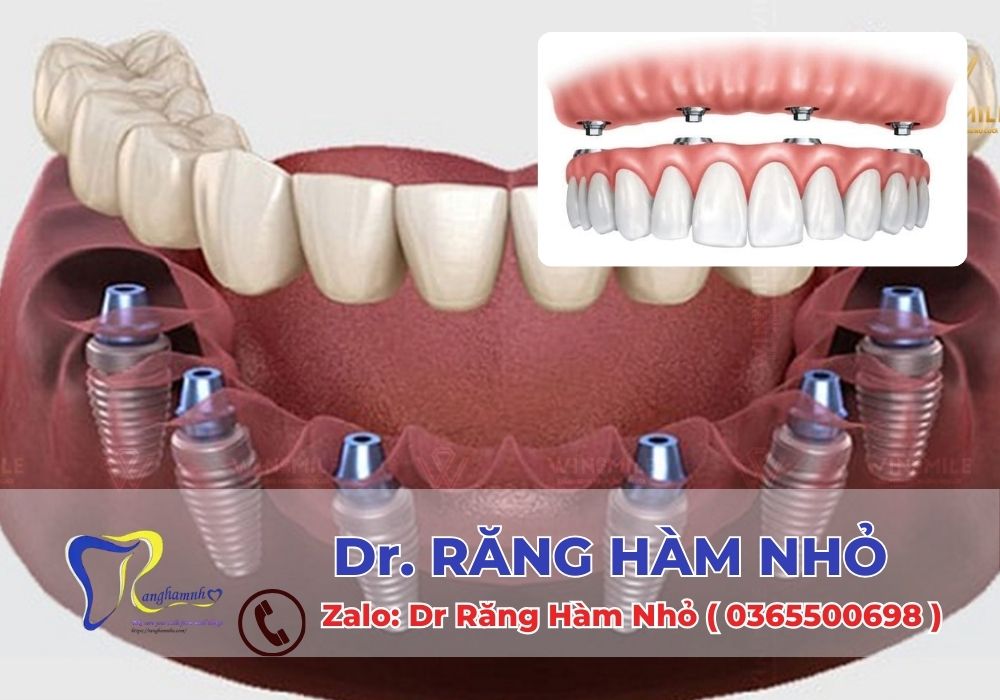 Hãy liên hệ ngay với Dr RĂNG HÀM NHỎ để được tư vấn cá nhân hóa theo tình trạng của bạn.