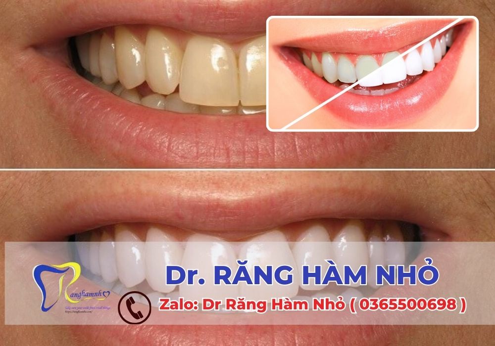 Sau khi tẩy trắng răng, việc chăm sóc răng miệng đúng cách là điều cần thiết để duy trì kết quả.