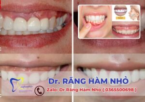 Cắt nướu thẩm mỹ giúp răng trông cân đối và đều đặn hơn, làm cho nụ cười trở nên tự tin hơn.