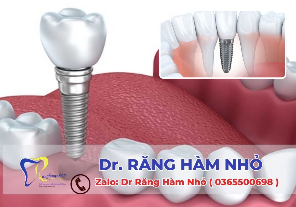 Nếu bạn đang tìm kiếm giải pháp khắc phục tình trạng mất răng an toàn, bền đẹp và hiệu quả, đừng bỏ qua dịch vụ trồng răng Implant tại Dr RĂNG HÀM NHỎ