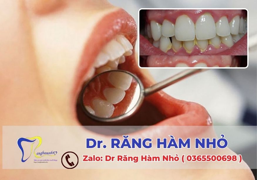 Tại Dr RĂNG HÀM NHỎ, chúng tôi cung cấp dịch vụ chăm sóc và điều trị bệnh nha chu chuyên sâu, ứng dụng công nghệ nha khoa hiện đại cùng đội ngũ bác sĩ giàu kinh nghiệm.