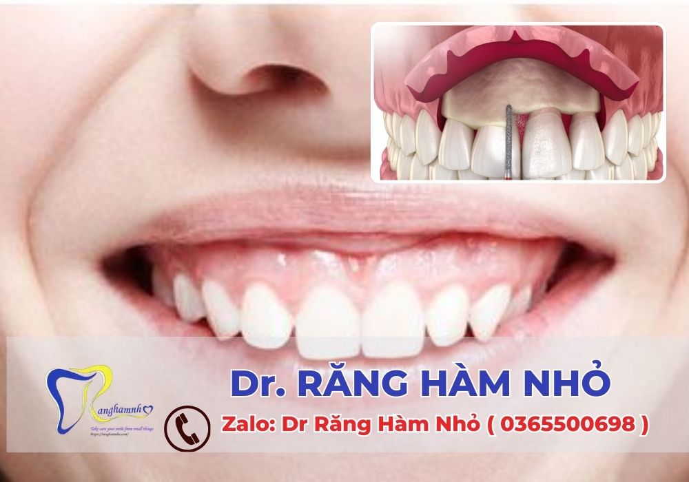 Thẩm mỹ nướu giúp điều chỉnh nụ cười duyên dáng, loại bỏ tình trạng cười hở lợi, tạo đường viền nướu đều đẹp, răng trông dài và sáng hơ