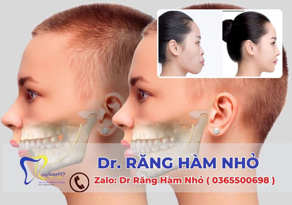 Hotline: ​0365500698 để được tư vấn chi tiết và đặt lịch thăm khám với bác sĩ chuyên khoa tại Dr RĂNG HÀM NHỎ.