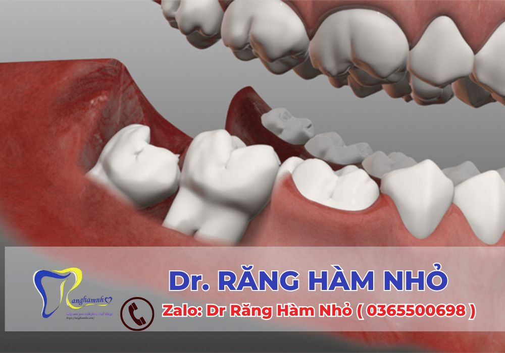 Việc nhổ răng khôn có thể gây ra một số tác động đến khớp thái dương hàm, nhưng với việc chăm sóc và thực hiện đúng cách, các vấn đề này sẽ được giải quyết