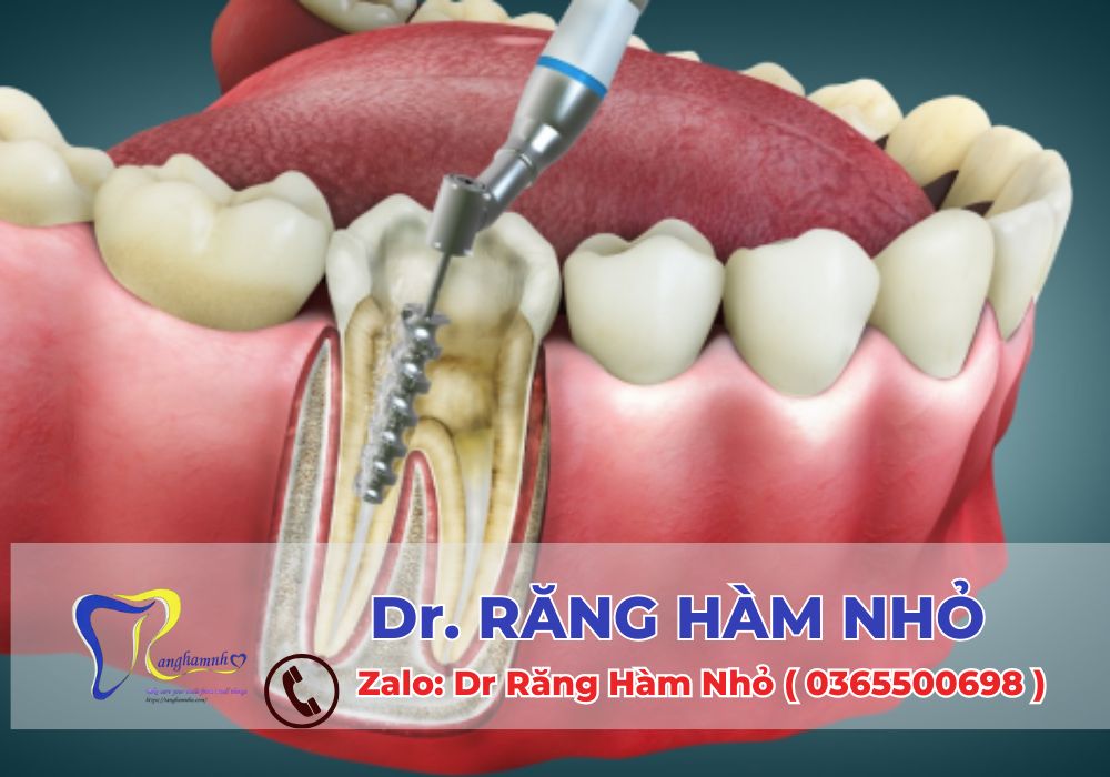Nếu bạn đang cần Điều trị tủy răng hoặc phục hình răng thẩm mỹ, an toàn, hãy đến ngay Dr RĂNG HÀM NHỎ