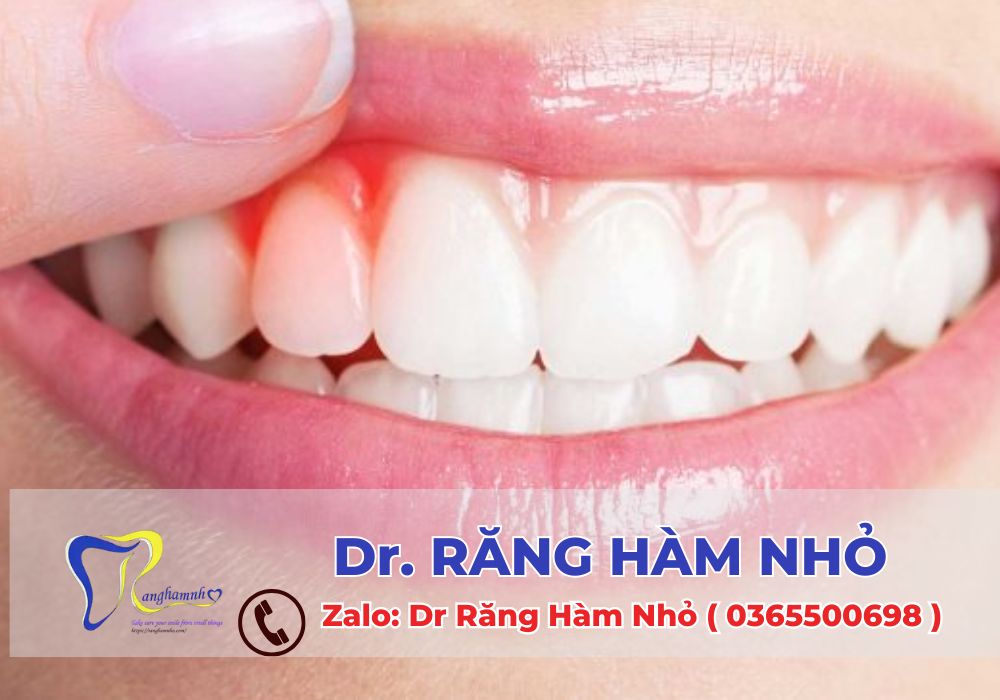 Viêm nha chu nếu không được điều trị kịp thời có thể gây mất răng sớm, ảnh hưởng thẩm mỹ, ăn nhai và sức khỏe toàn thân.