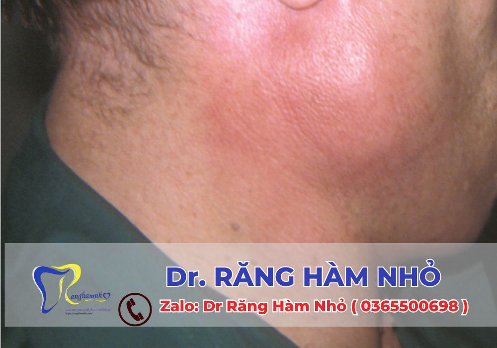 Viêm tuyến nước bọt có thể được chữa khỏi hoàn toàn nếu được điều trị đúng cách và kịp thời.